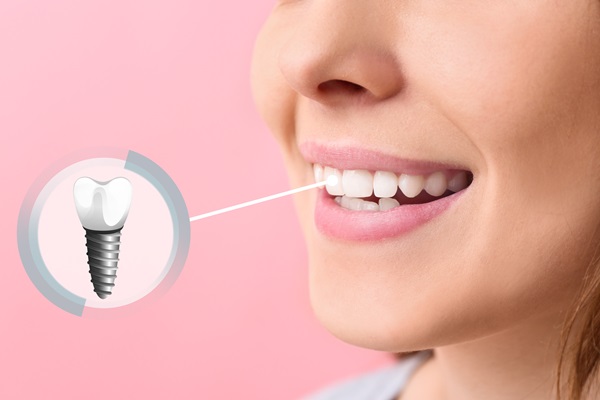 What To Ask Your Dentist About Dental Implants